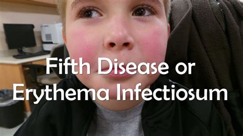 fifths disease rash pictures - pictures, photos