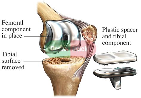 Total Knee Replacement Doctor Stock