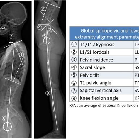 Radiographic Sagittal Parameters In The Standing Position Download