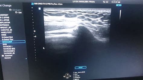 Subacromial Impingement On Ultrasound Youtube