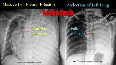 Pleural Effusion Vs Atelectasis Youtube