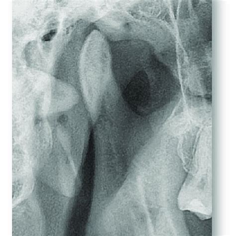 Radiografía Atm Lateral Boca Abierta Y Cerrada Cortesía Dra Download Scientific Diagram