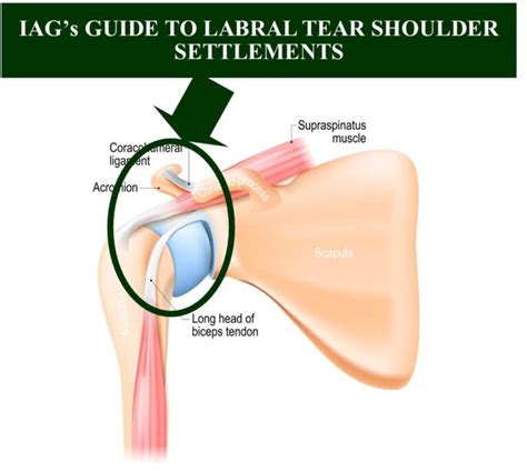 Labral Tear Shoulder Settlement Guide 2022 Update