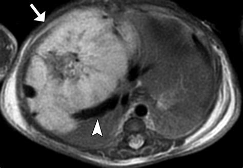 Pediatric Liver Masses Radiologic Pathologic Correlation Part 1