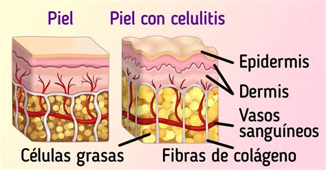 Qué es la celulitis y cómo se forma Ideas En 5 Minutos