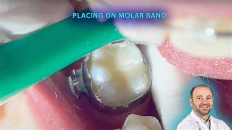 Cementing The Molar Band Steps For A Molar With Big Restoration From