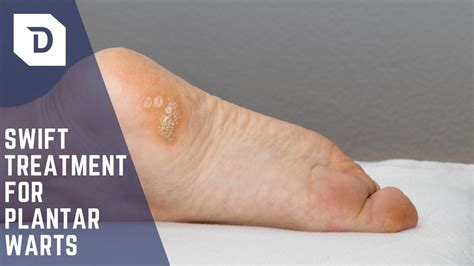 Swift Microwave Therapy — The Best Treatment For Plantar Warts