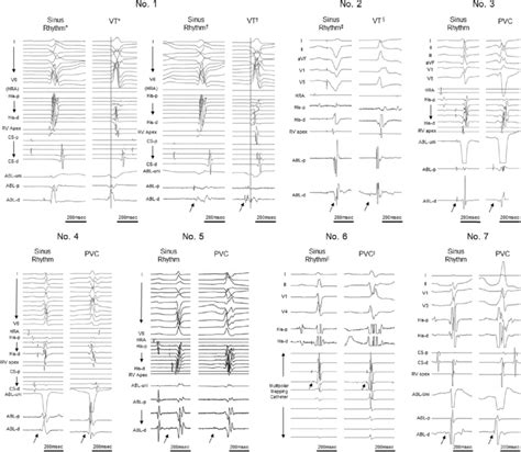 Intracardiac Electrocardiogram Of Proximal Type During Sinus Rhythm And