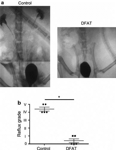 Comparison Of Vesicoureteral Reflux Vur Grade Between Control And Download Scientific Diagram