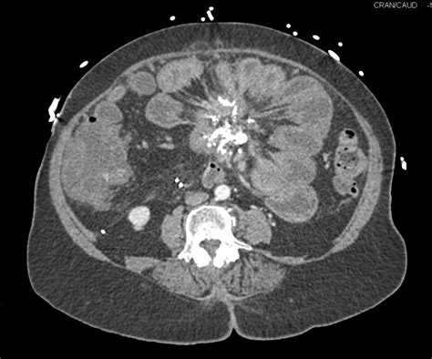 Carcinoid Tumor Root Of Mesentery With Desmoplastic Reaction Small