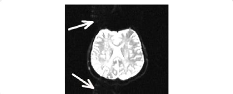 A Typical Example Of An N2 Ghosting Artifact Commonly Seen In Dti Data