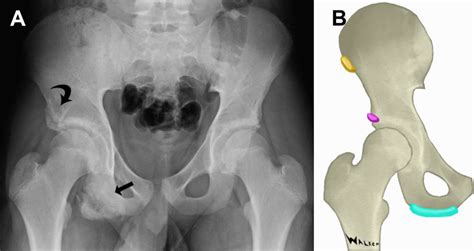 Ischial Tuberosity Avulsion Potentially Misdiagnosed As Periosteal