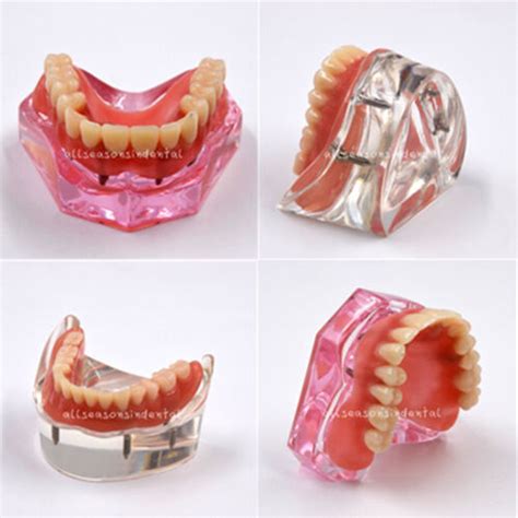 Dental Restoration Model Overdenture Inferior Teeth With