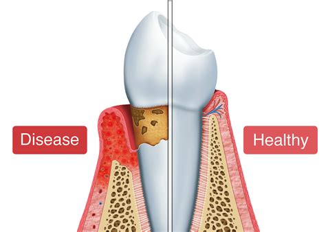 Periodontal Treatment - Amity, AR - Amity Gentle Dental