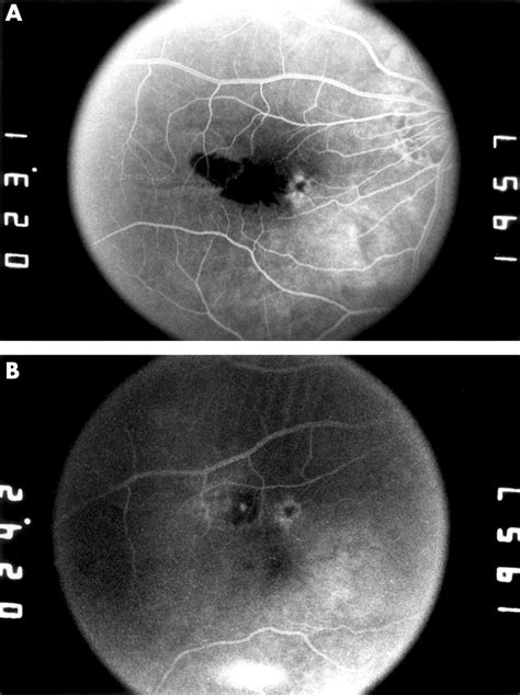 Limited Macular Translocation With Scleral Retraction Suture British