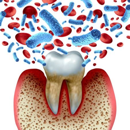 Piorrea Malattia Paradontale Sintomi Cause Cura