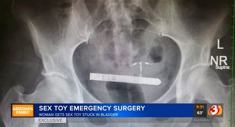 Woman Gets Surgery After Vibrator Gets Stuck In Her Bladder Still Buzzing The Us Sun The Us Sun