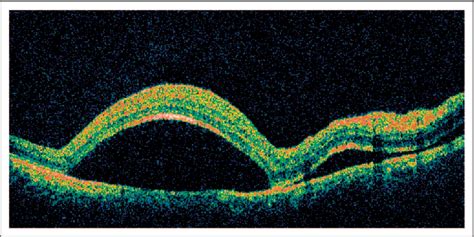 Figure 1 From Bilateral Choroidopathy In Systemic Lupus Erythematosus