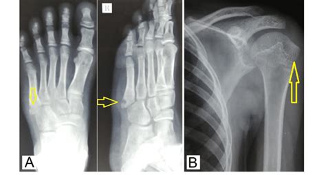 X Ray Of The Right Foot Showing A Geographic Lytic Lesion With Download Scientific Diagram