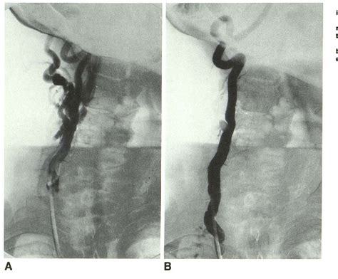 Figure 2 From Treatment Of Vertebral Arteriovenous Fistulas Semantic