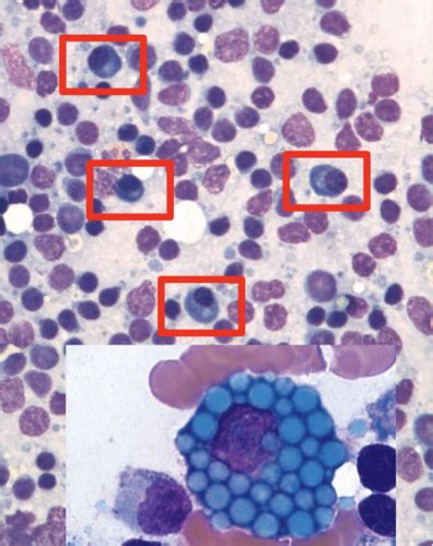 HOLS session 3.1: Diagnosis of lymphoproliferative disorders Flashcards ...