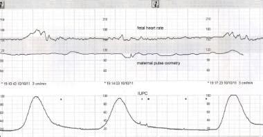 Intrauterine Pressure Catheter Placement ~ JPEEI CLINIC