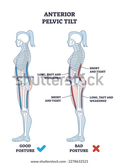 Anterior Pelvic Tilt Before And After