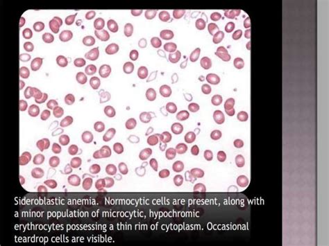 Approach To Microcytic Hypochromic Anemia