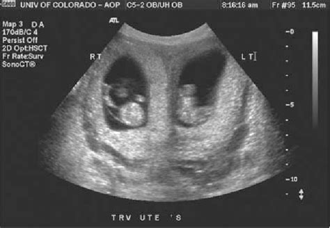 Figure 1 From Uterus Didelphys And Dicavitary Twin Pregnancy Semantic