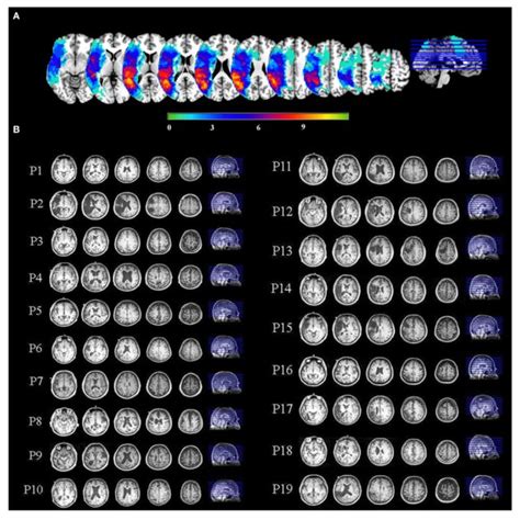 A An Overlay Of Stroke Patients Lesion Distributions Displayed On