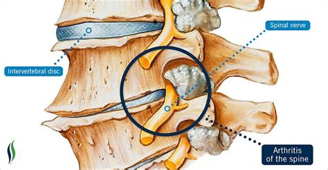 How To Detect Arthritis Of The Spine Arthritis Spinal Arthritis