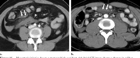 Figure 4 From Evaluation Of Bowel And Mesenteric Blunt Trauma With