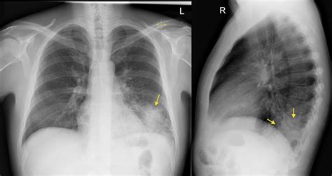 Left Lower Lobe Pneumonia Lateral Cxr Radiology At St Vincent S