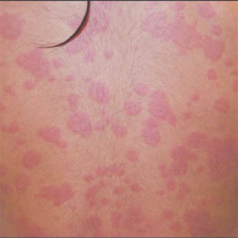 Pdf Urticaria Multiforme