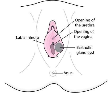 Bartholin S Cyst Treatment An Ayurvedic Doctor S Guide