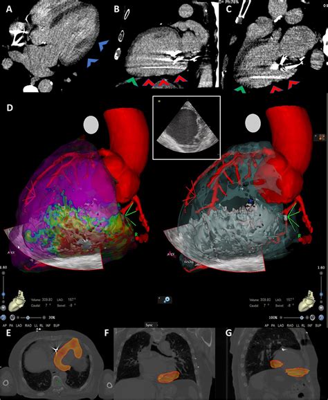 CT Imaging With Myocardial Fibrosis Evaluation Integrated