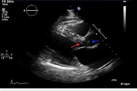 Transthoracic Echocardiogram Parasternal Long Axis View Showing