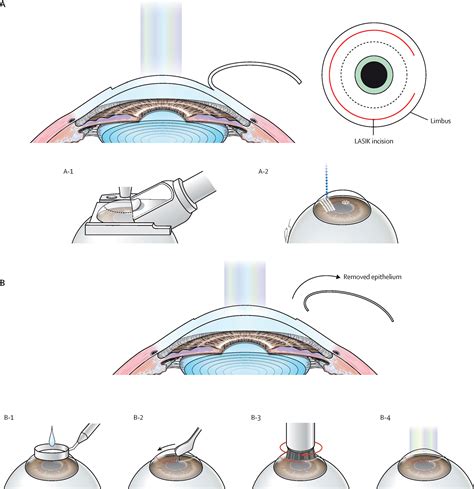 Refractive Surgery The Lancet