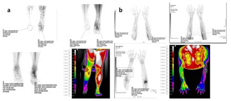 Diagnostic Performance Of Three Phase Bone Scintigraphy And Digital