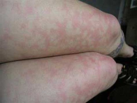 What Causes Blotchy Skin on Legs? | Blotchy skin, Red skin blotches ...