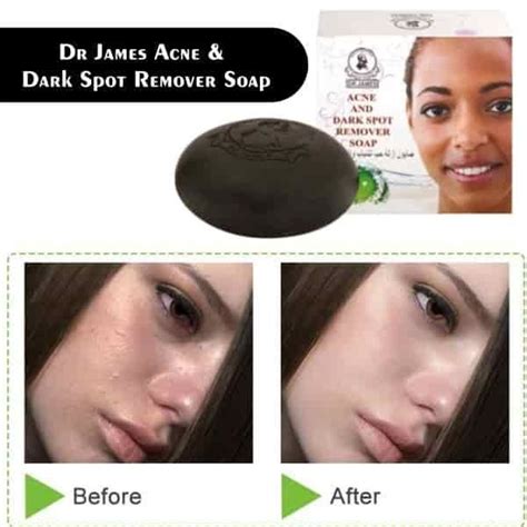 Dr James Acne And Dark Spot Remover Soap