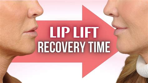 Lip Lift Recovery Time Lesson Of The Day Youtube