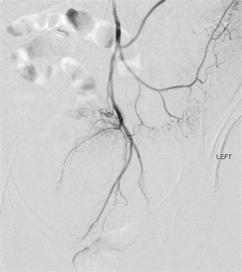 Visceral Embolization Case Albany Ir