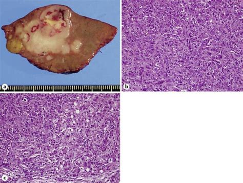 Pathological Findings Of Tumor In Segment 6 A Macroscopically The