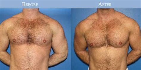 Male Plastic Surgery Procedures Business Insider