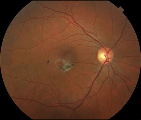 Idiopathic Juxtafoveal Retinal Telangiectasis