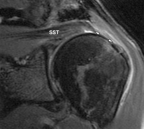 Mr Imaging Of Rotator Cuff Injury What The Clinician Needs To Know