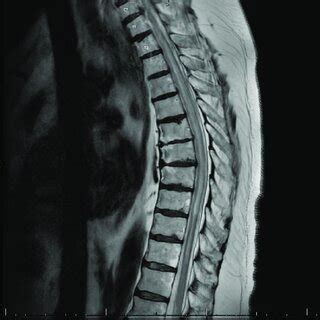 MRI Of The Thoracic Spine Sagittal T2 Weighted Image Showing Multilevel