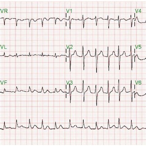 Ecg At Admission Showed Atrial Fibrillation With Rapid Ventricular Download Scientific Diagram