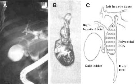 A Endoscopic Retrograde Cholangiography Shows A Smooth Oval Filling